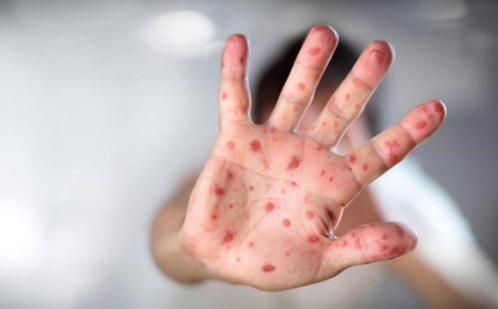 Tay Chân Miệng Ở Trẻ Em: Dấu Hiệu Nhận Biết, Nguyên Nhân Và Cách Phòng Ngừa Hiệu Quả