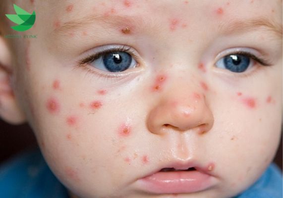 Sốt Virus Ở Trẻ Em Mùa Mưa: Nguyên Nhân, Dấu Hiệu Và Cách Phòng Ngừa