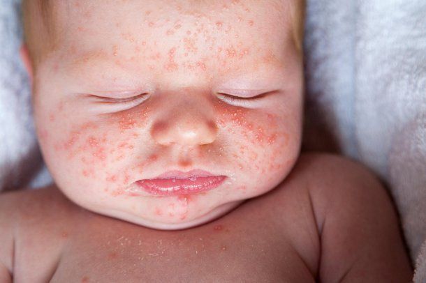 Rôm Sảy, Viêm Da Mùa Hè: Nguyên Nhân, Dấu Hiệu Và Cách Phòng Ngừa Hiệu Quả